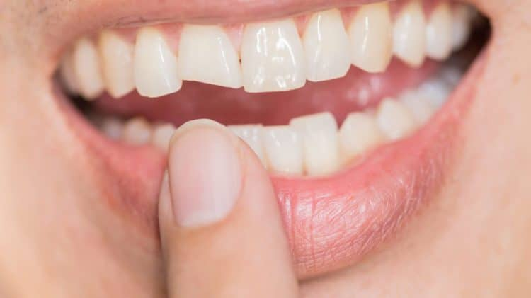Răng bị mẻ – Nguyên nhân và cách xử lý răng bị mẻ tại nhà