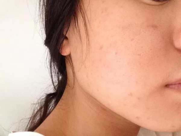 Mẹo thu nhỏ lỗ chân lông tại nhà đơn giản