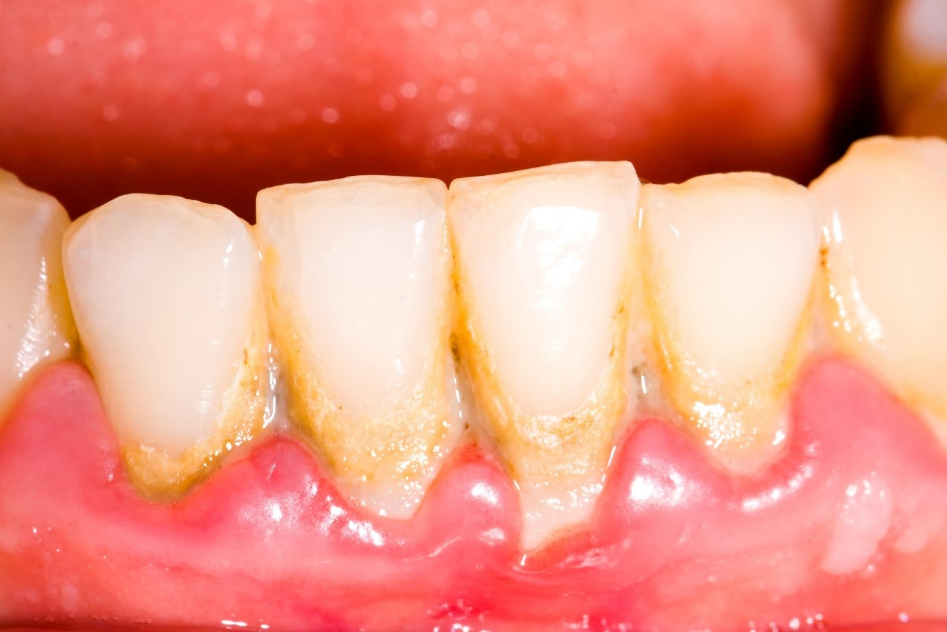 Mách bạn bí quyết khắc phục tình trạng răng có chấm đen hiệu quả nhất