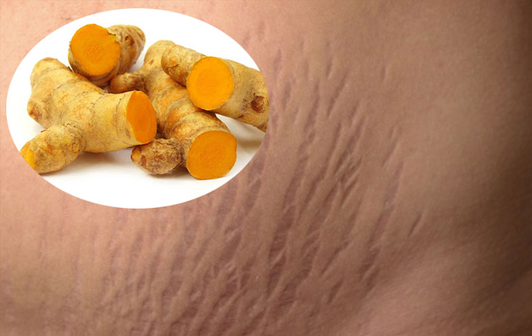 Những cách trị rạn da bằng nghệ tươi an toàn dễ thực hiện