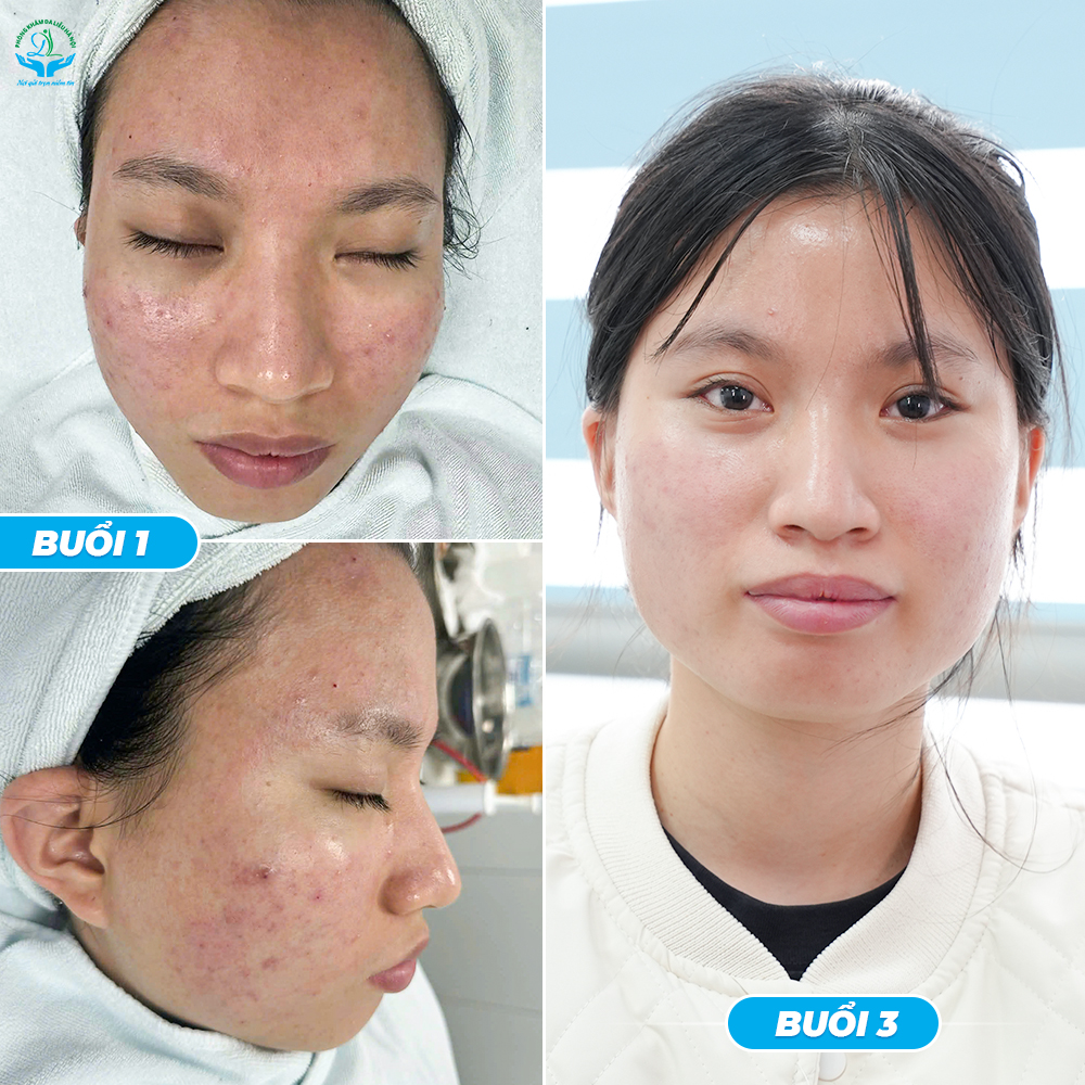 cách trị mụn mủ sưng đau hiệu quả tại nhà từ bác sĩ da liễu